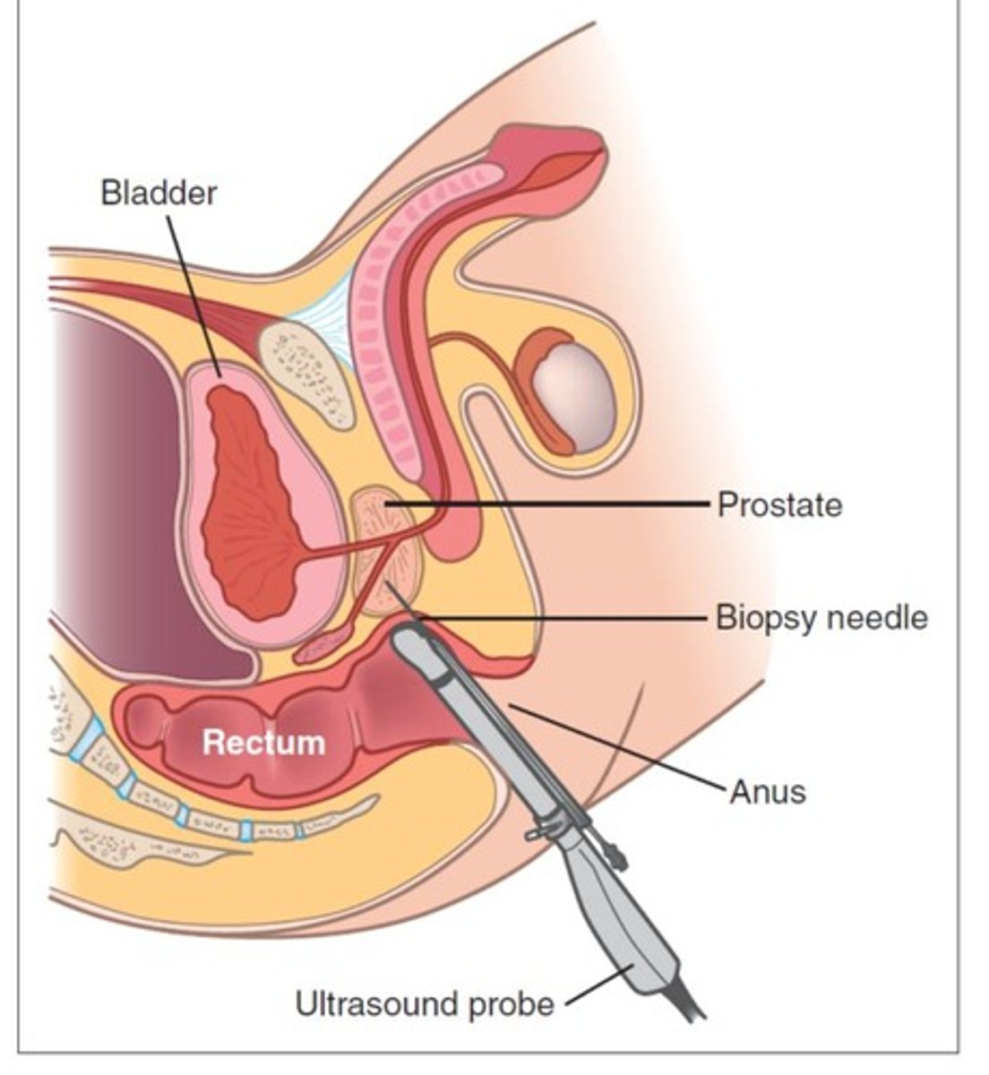 <p>Possible MRI to aid decision making, prostate needle biopsy is definitive &amp; required for diagnosis</p>