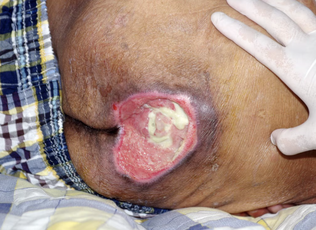 <p>what stage of pressure wound is this?</p>