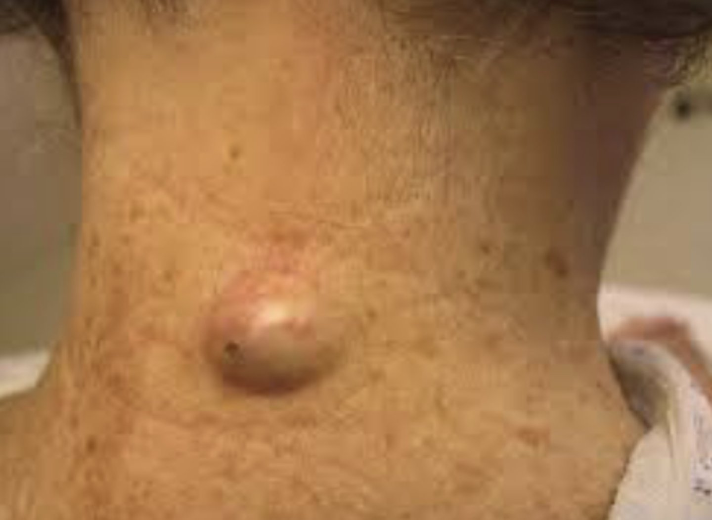 <p>A raised, solid lesion greater than 1.0 cm that may occur in the epidermis, dermis, or subcutaneous tissue</p>