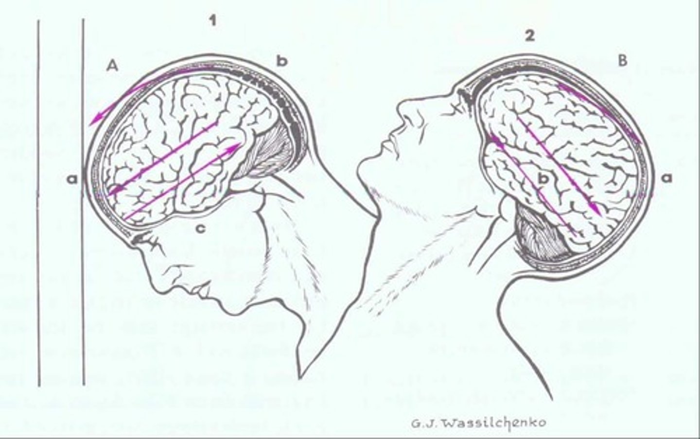 <p>Injury from brain rebounding against skull.</p>