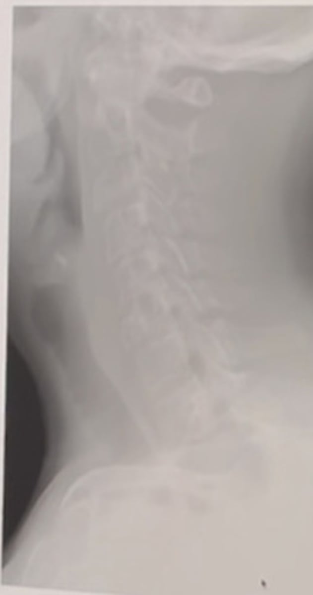 <p>The most likely diagnosis for the above finding is:</p><p>Lytic metastasis</p><p>Hyperparathyroldism</p><p>Hemangioma</p><p>Paget disease-</p>