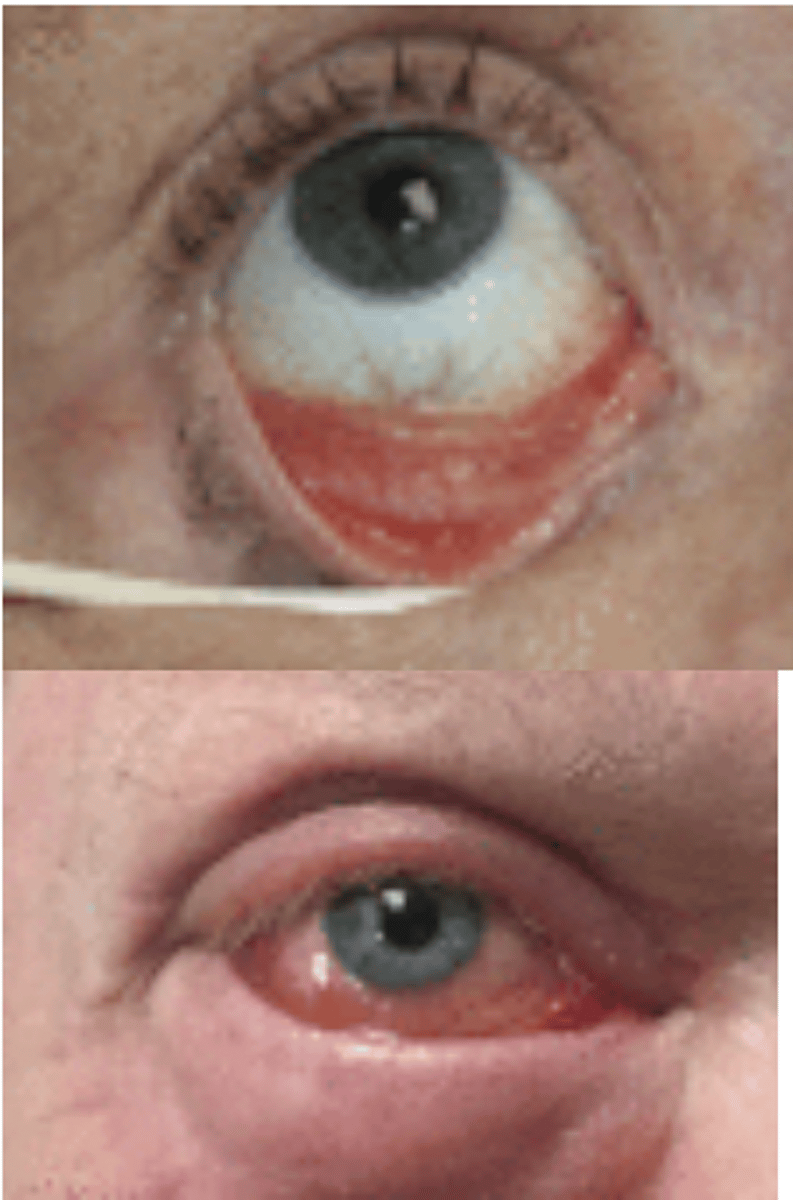 <p><u>Etio</u>: COVID</p><p><u>S&amp;S</u>: Acute conjunctivitis symptoms, redness, ocular irritation, eye soreness, FB sensation, <strong>watery discharge</strong>, eyelid swelling, congestion, chemosis</p><p><u>Tx</u>: Still being studied, Tx COVID &amp; emergency consult to ophthalmology</p>