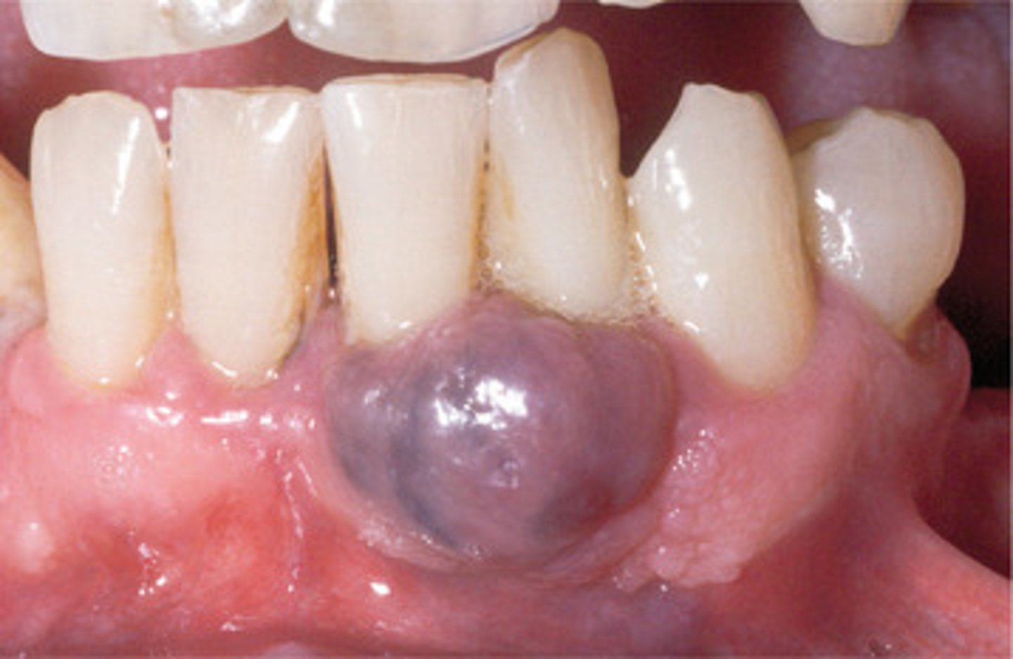 <p>• blue-red mass </p><p>• can be ulcerated</p><p>• cups bone</p><p>• granulation tissue + giant cells + RBCs</p><p>• common location: anterior gingiva</p><p>• population: adults 40-60</p>