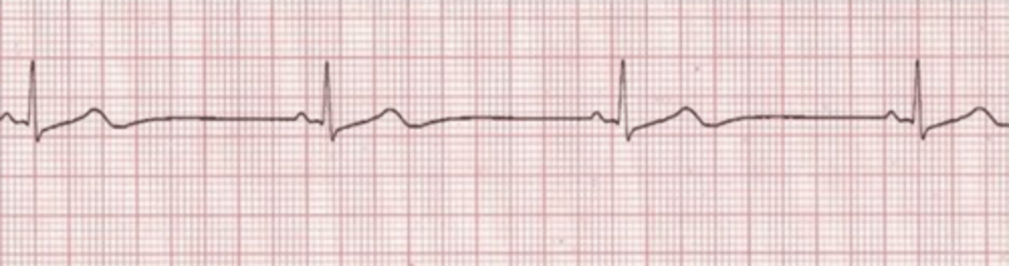<p>A patient on the telemetry floor complains of SOB and feels weak. Skin cool, diaphoretic, BP 78/50, RR 24. The following rhythm is on the cardiac monitor. The nurse activates the rapid response team and anticipates an order for:<br>A. Amiodarone IV push<br>B. Cardioversion<br>C. Atropine IV push<br>D. Norepinephrine infusion</p>