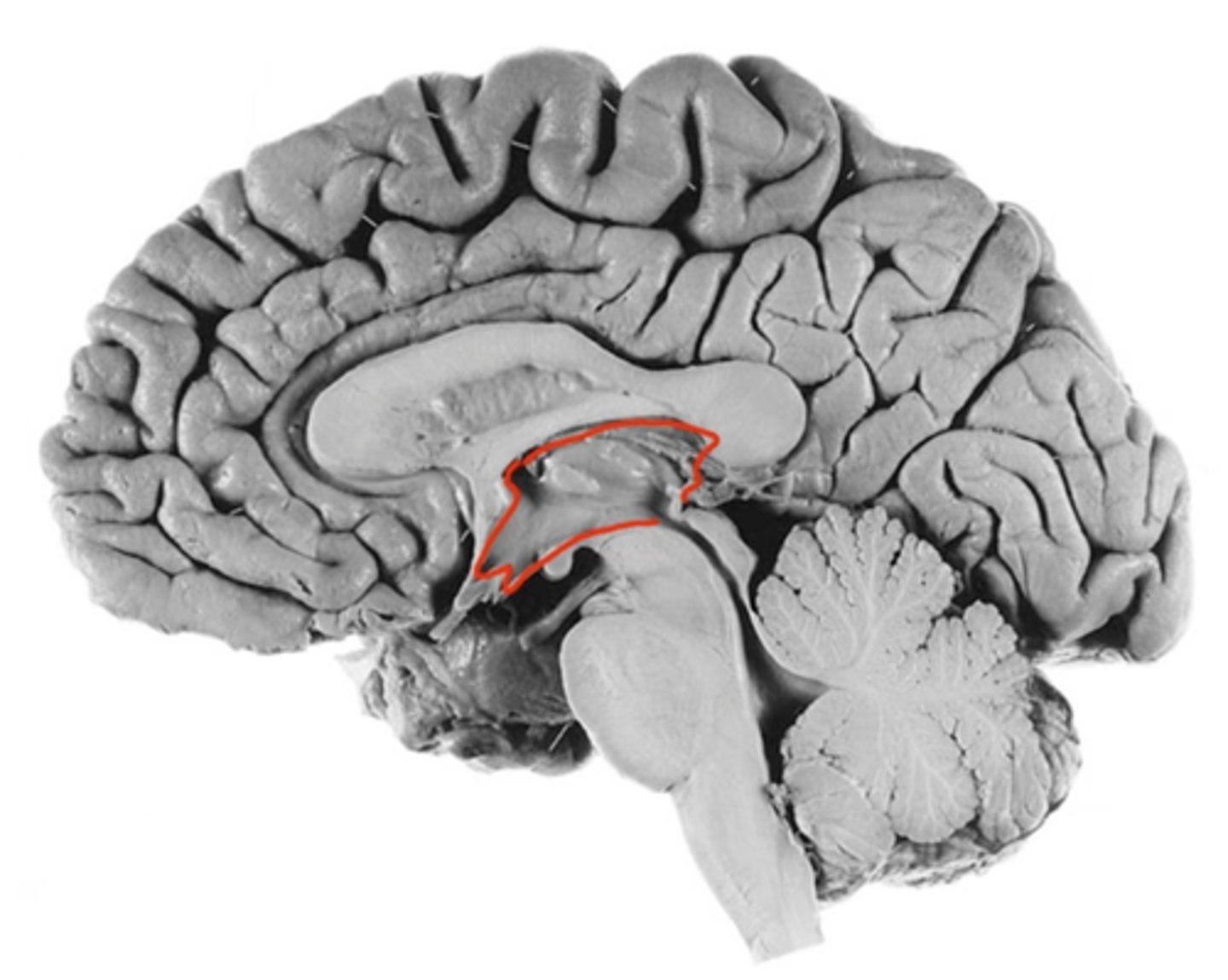 <p>found in the diencephalon and communicates with lateral ventricles via intraventricular foramen</p>