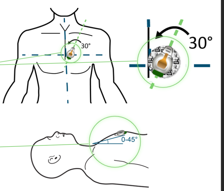 <p>PRS-A: directly over the heart, 30 angle to the left from midline, routed over left clavicle, no more than 45 degrees relative to the patient table</p><p></p>