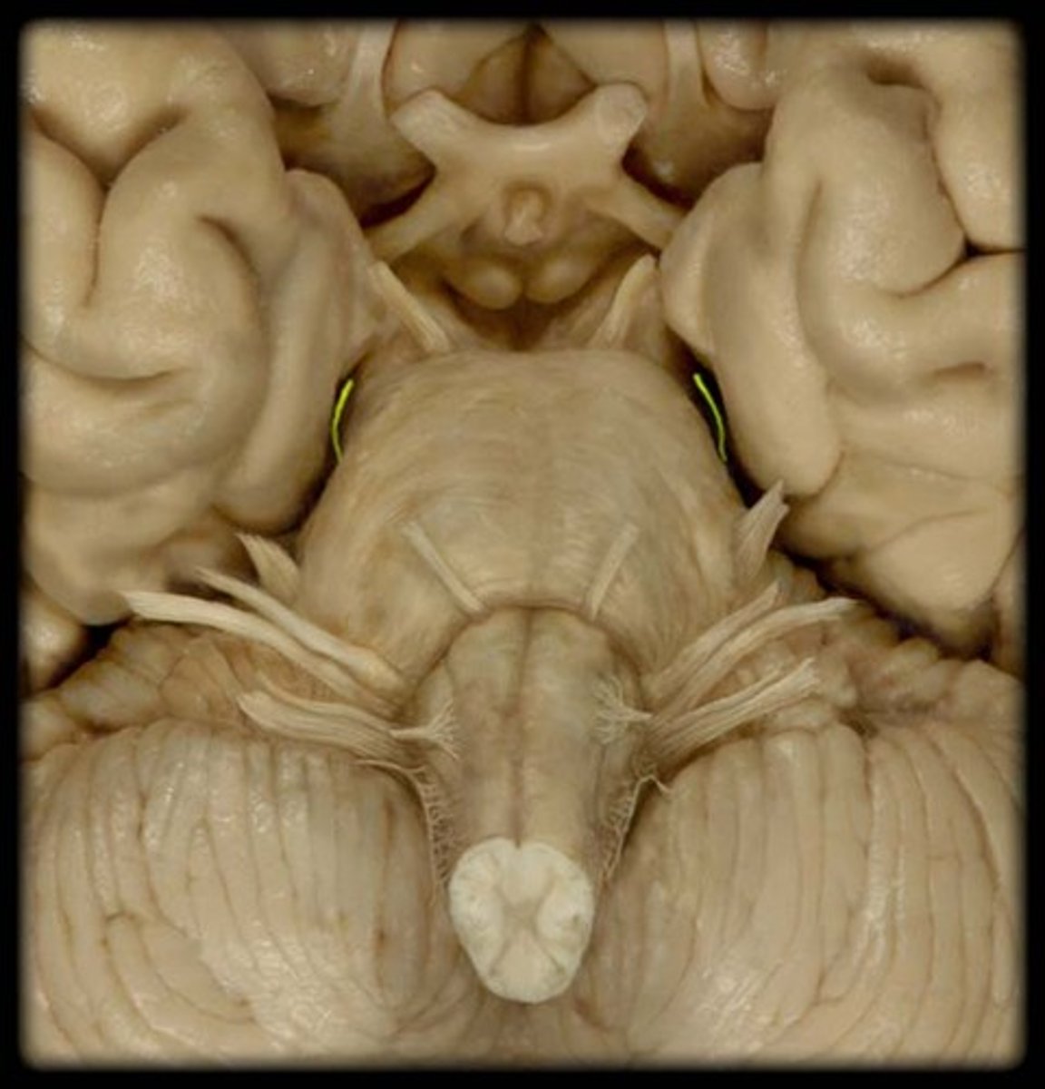 <p>-in fold off posterior midbrain</p><p>-very small fibers</p><p>-posterior to CN III</p>