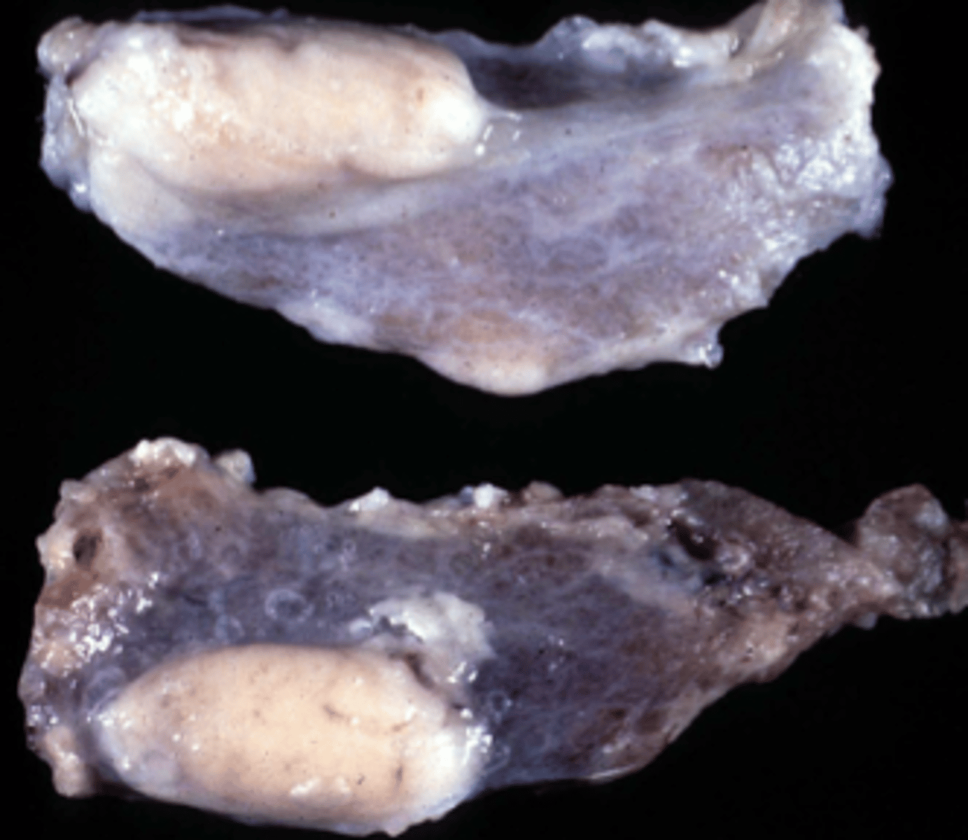 <p>What type of cellular adaptation is shown in this photo?</p>