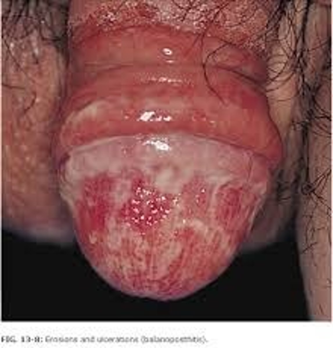 <p>inflammation of the skin covering the glans penis; candidiasis</p>