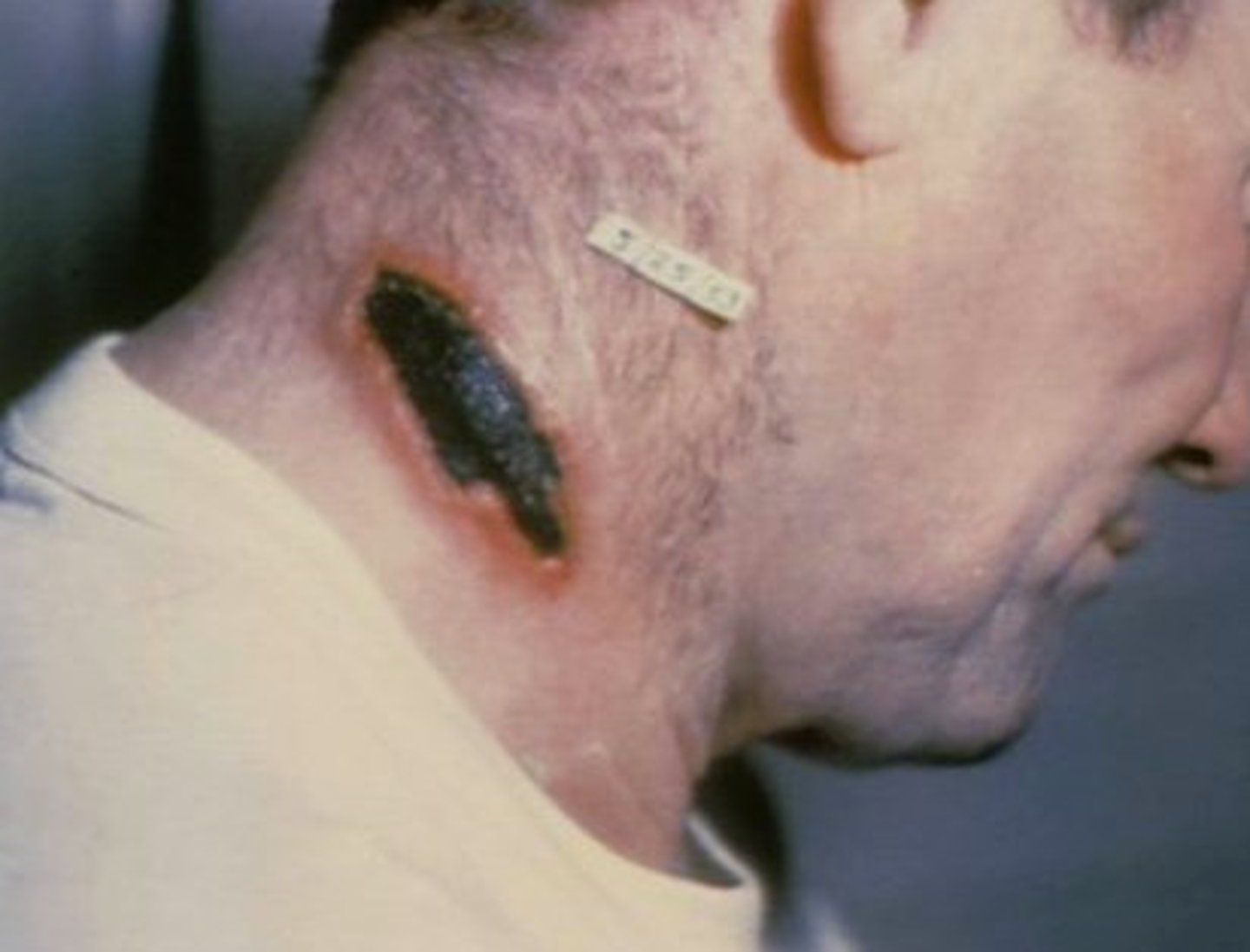 <p>painless, pruritic black eschar at inoculation site with massive edema around (necrotic ulceration)</p>