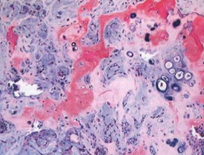 <p>Describa los hallazgos histológicos presentes en cada una de las lesiones neoplásicas:</p>