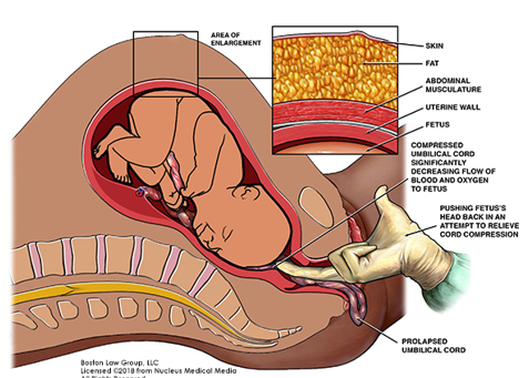 <ul><li><p>Membranes must be ruptured.</p></li><li><p>Part of the cord drops through the opening of the cervix.</p></li><li><p>Part of the baby’s body pushes on the cord.</p></li><li><p><strong>Interventions:</strong></p><ul><li><p>Must hold the presenting part of the infant off the cord until the baby is delivered by C-section.</p></li></ul></li></ul><p></p>