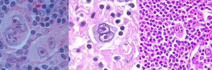 <p>A. Identify the abnormality / cell </p><p>B. This is seen in what condition / disease </p><p>C. What is the appearance?</p>