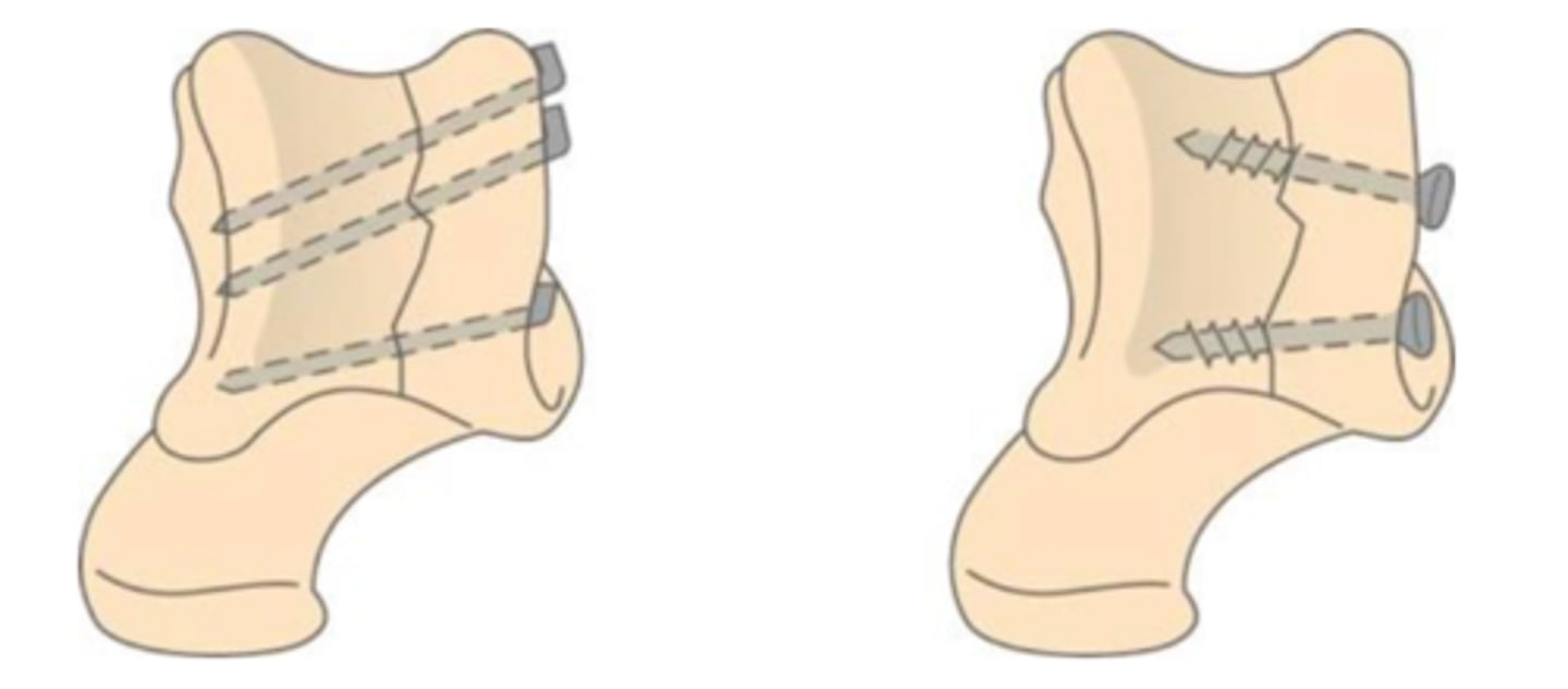 <p>What is happening here? Describe each of the fractures and the treatment.</p>