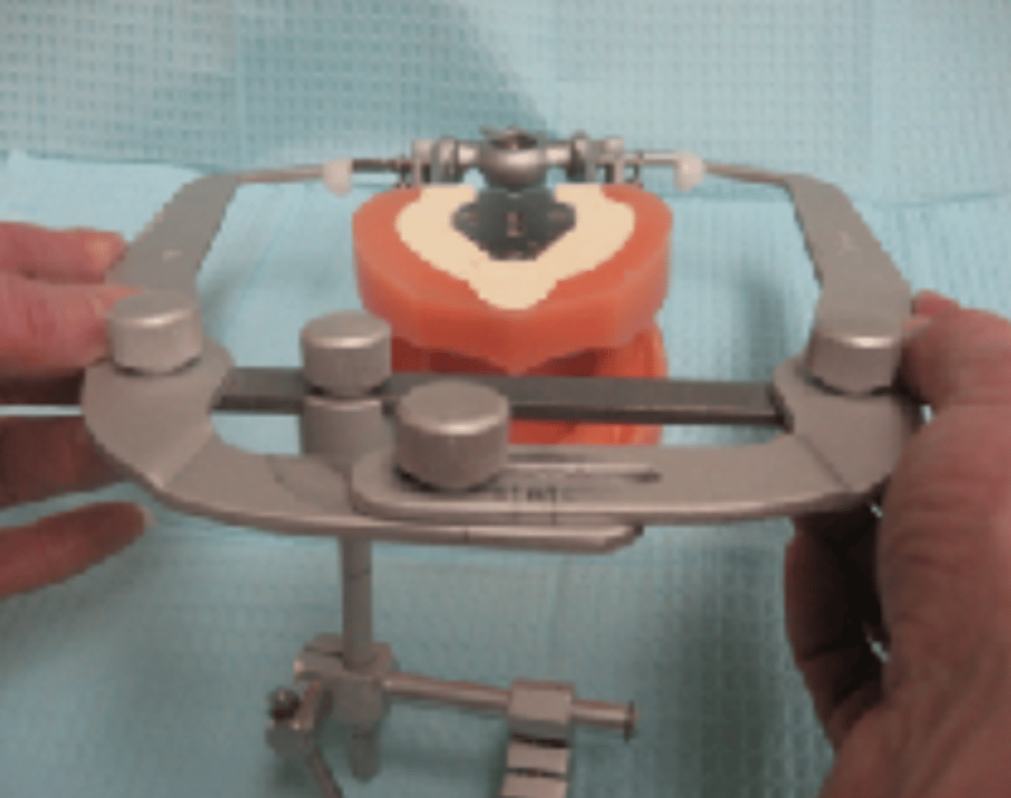 <p>When attaching the facebow to the typodont, where do the plastic ear tips go?</p>