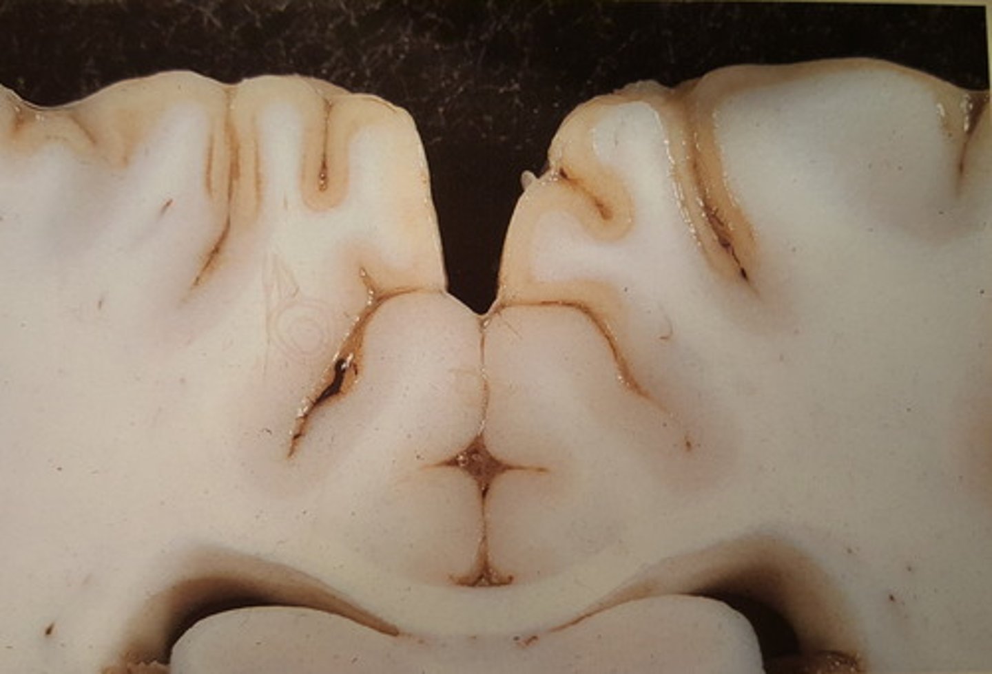 <p>Hjerne fra okse. Patoanatomisk diagnose?</p>