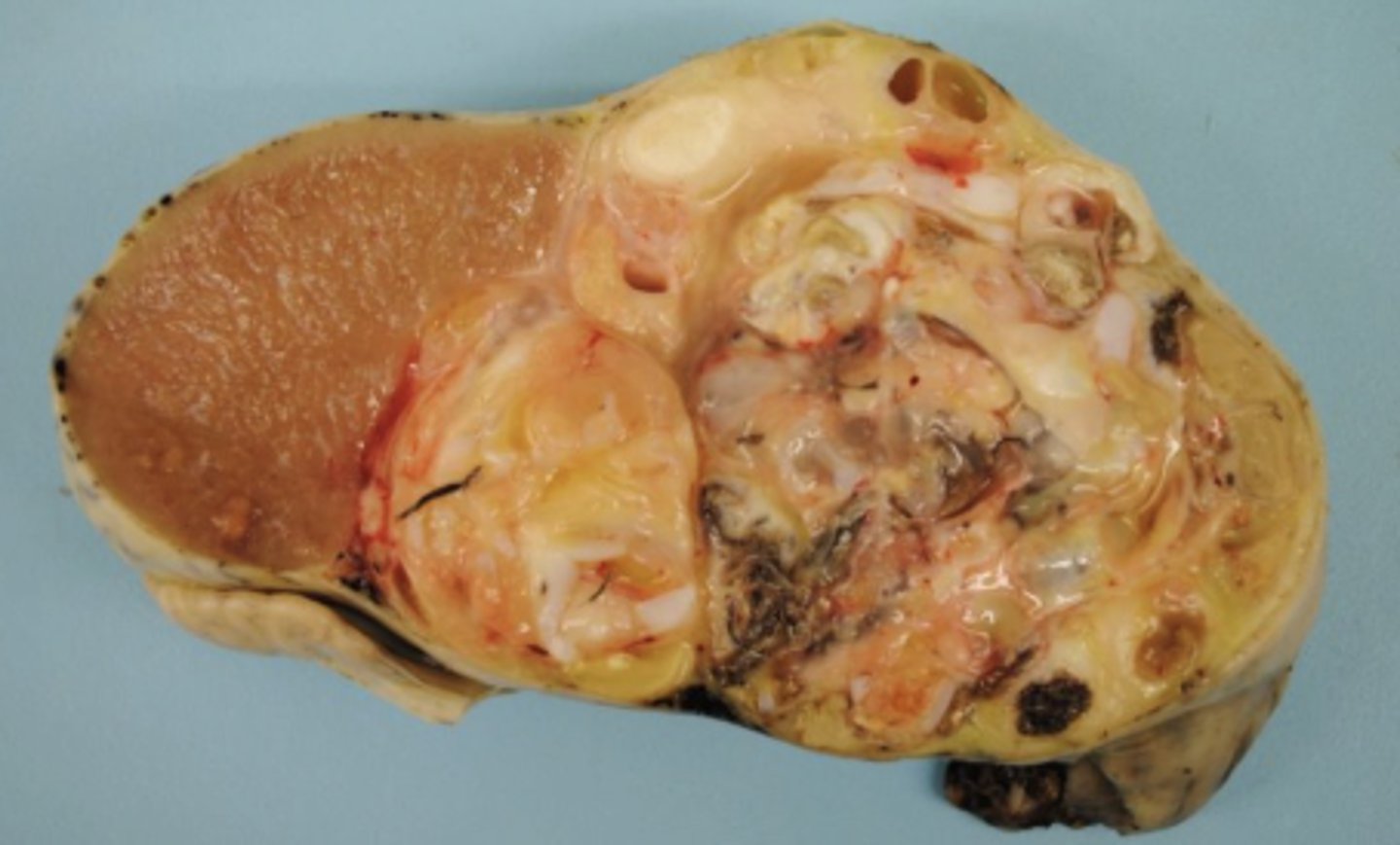 <p>What kind of tumor is this?</p>