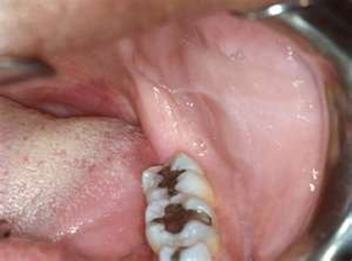 <p>linea alba</p><p>tx: remove the irritants is the proper treatment</p>