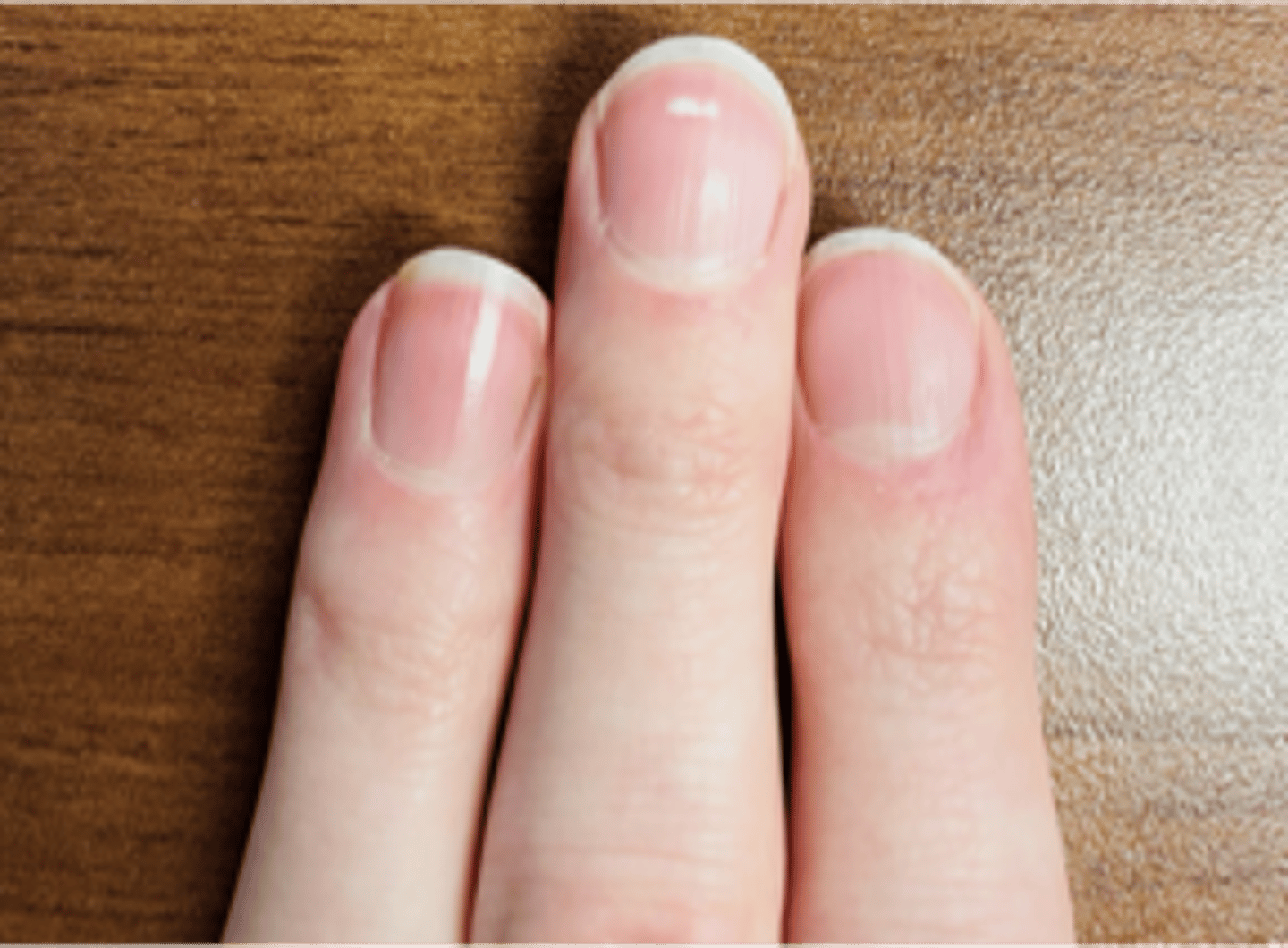 <p>name this nail abnormality</p>