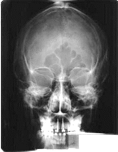 <p><strong>What angulation is used in this PA projection image?</strong><br><span>A. 15 degrees cephalic</span><br><span>B. 15 degrees caudad</span><br><span>C. 25 degrees caudad</span><br><span>D. 0 degrees</span></p>