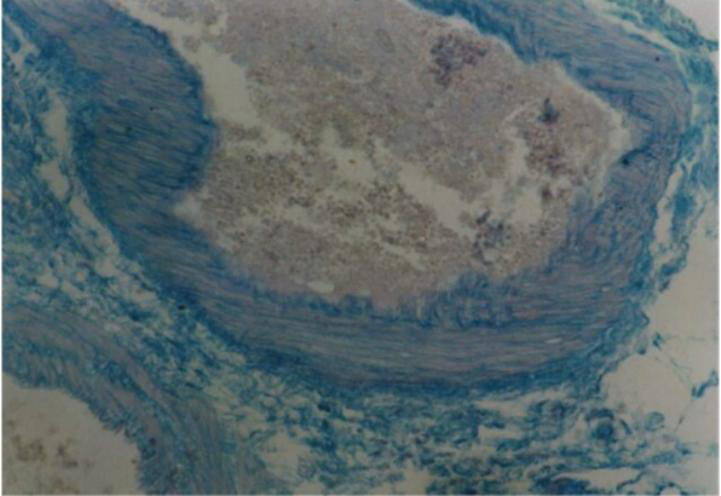 <p>Basic defect of mucopolysaccharidosis is the absence or loss of critical _________ usually from genetic disorders</p>
