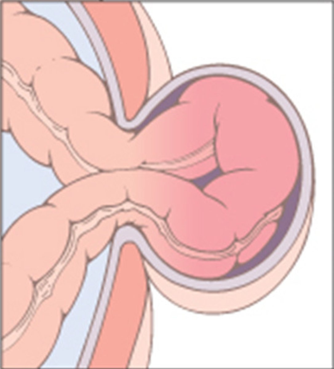 <p>happens when a part inside your body, like an organ, pushes out through a weak place in the muscle that usually holds it inside.</p>