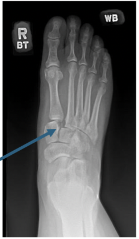 <p>MOI of Lisfranc fractures</p>