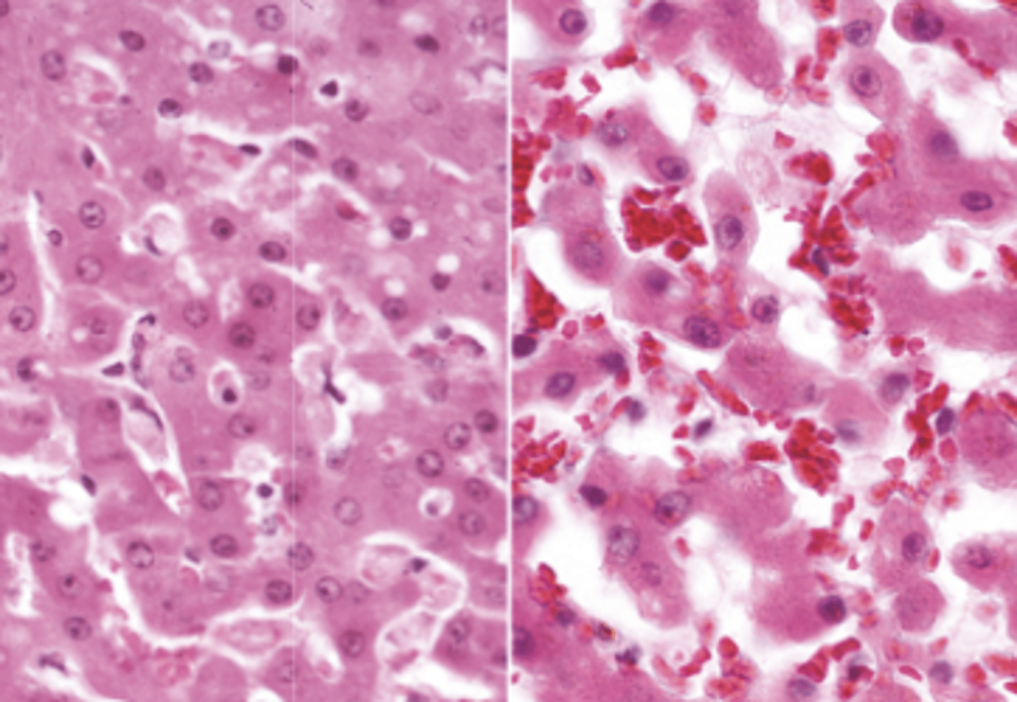 <p>What type of cellular adaptation is shown in this photo?</p><p>Normal is on the left</p>