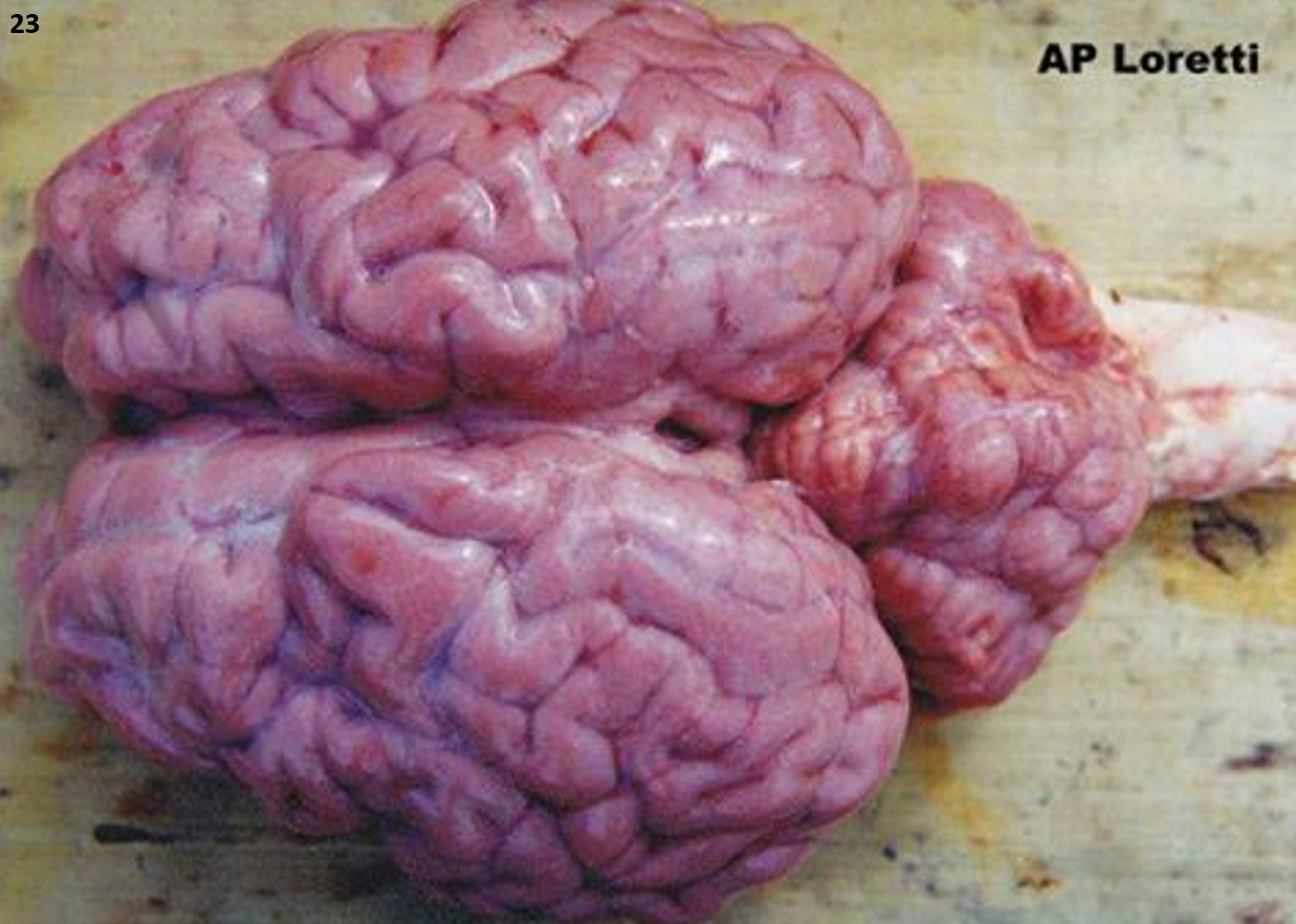<p>23.<span>&nbsp; </span>Tissue from a calf.<span>&nbsp; </span>Which of the following is NOT true?</p><ol type="a"><li><p>The cerebral flush seen here is seen only with <em>Babesia bovis </em>and no other species of <em>Babesia</em>.</p></li><li><p>Hemolytic anemia is not a feature of this condition.</p></li><li><p>The flush is the result of marked dilation and congestion of cerebral vessels with parasitized erythrocytes.</p></li><li><p>Splenomegaly is almost always seen in this condition.</p></li></ol><p></p>