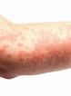 <p>causes erythema</p>