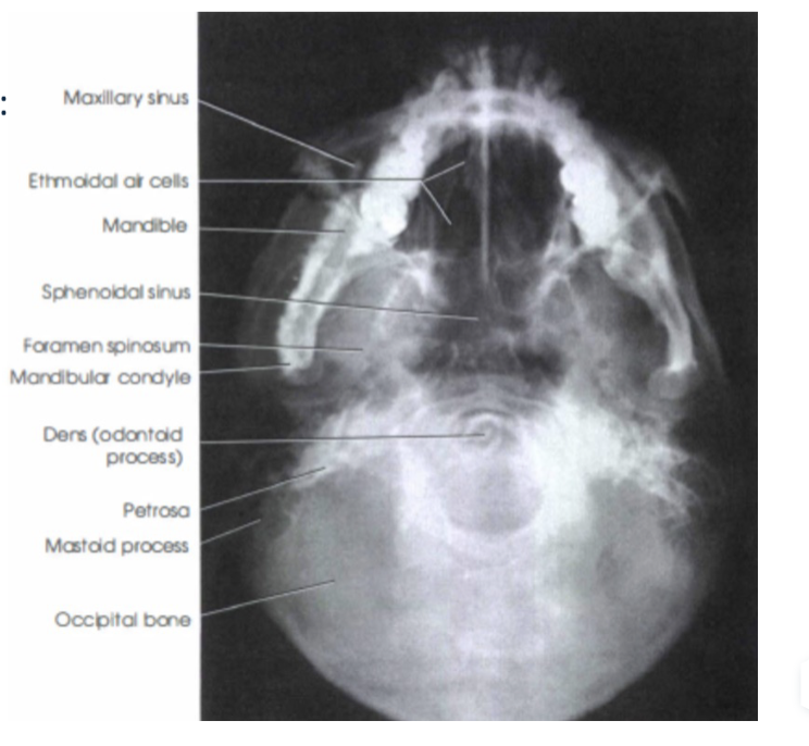<p>Sensor is placed vertically. Patient extends head and neck backwards so that the Frankfort line is perpendicular to the floor and parallel to the sensor plane.</p>