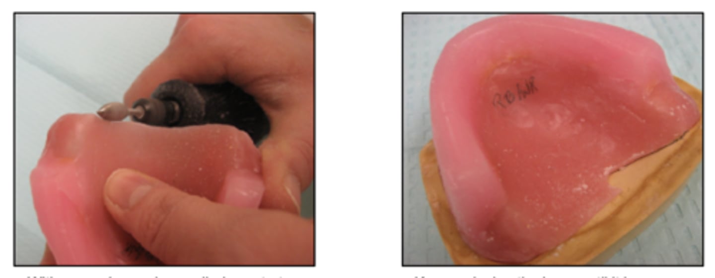 <p>When do you keep reducing the base with a pineapple acrylic bur to?</p>