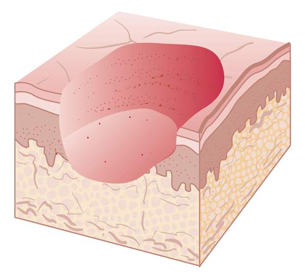 <p>destruction of epidermis in a area</p>