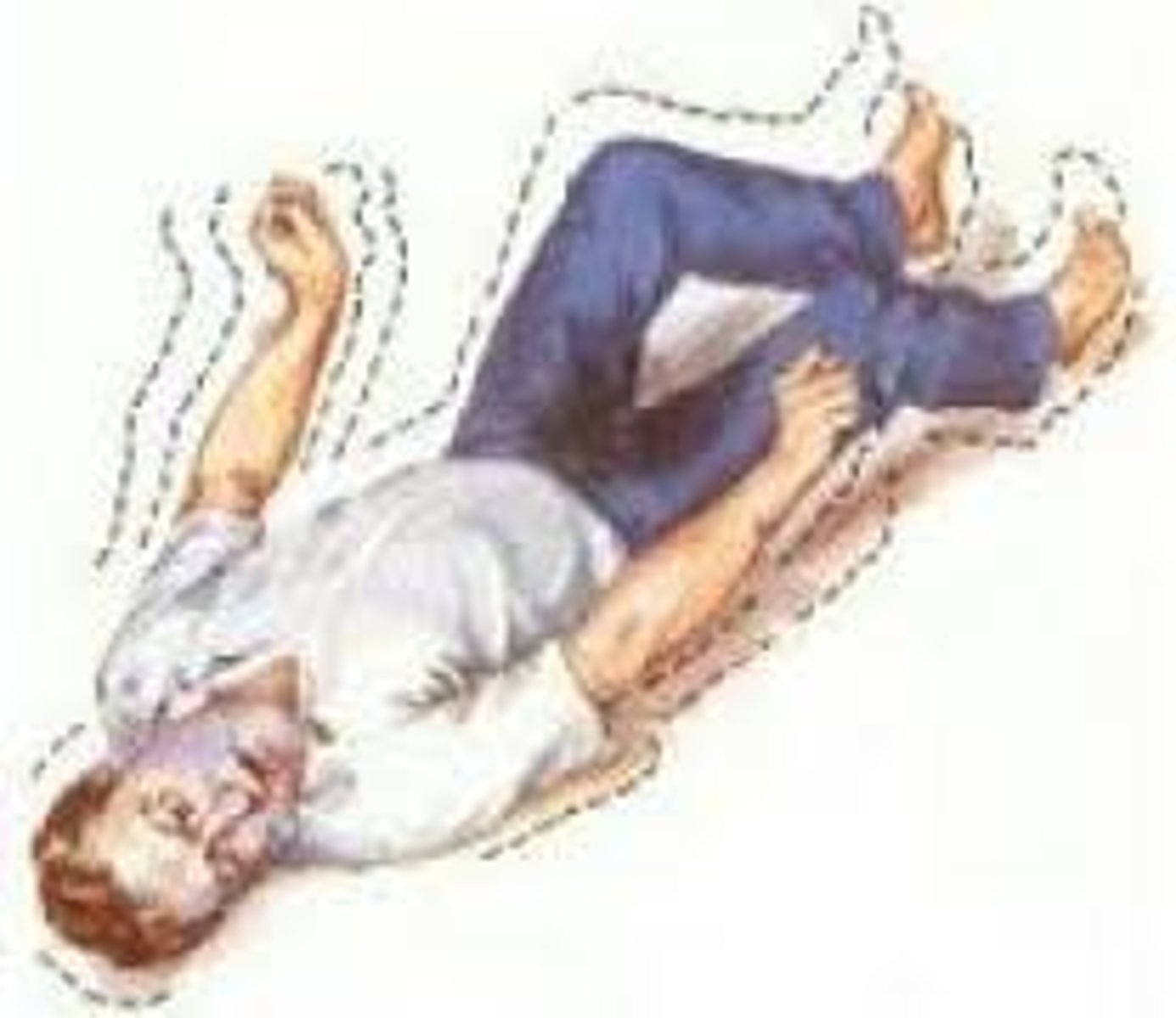 <p>Abnormal brain cell activity; results in confusion, uncontrolled movements; treat with anti-epileptic drugs and removal of defined area within the brain</p>