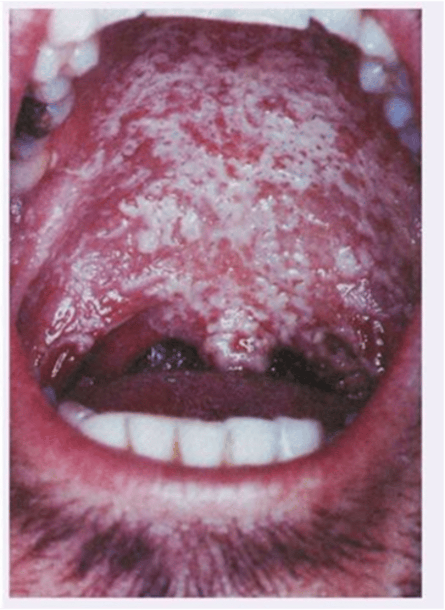<p>This patient has been diagnosed with an autoimmune disease and has been on antibiotics of a severe tooth infection recently prior to the onset of this white accumulation on the oral pharynx. It can be scraped off but returns quickly. What is the diagnosis of the oral pharynx?</p><p>- Acute bacterial pharyngitis</p><p>- Retropharyngeal abscess</p><p>- Candidiasis</p><p>- Peritonsillar abscess</p>