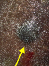 <p>What type of equine melanoma is seen in young horses of any colour?</p>