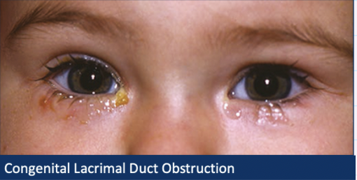 <ul><li><p>Epiphora + <strong>mucous dsicharge</strong></p></li></ul><p></p><ul><li><p>Mucopurulent discharge if infected</p></li></ul><p></p><ul><li><p><u>Pressure</u> over lacrimal sac may cause <u>mucous reflex</u></p></li></ul><p></p>