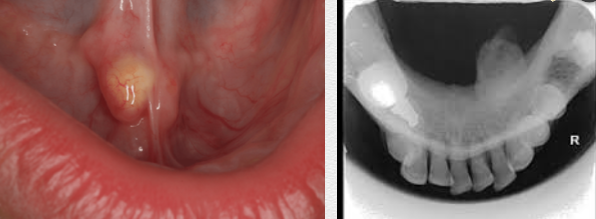 <p>presence of<span style="color: red;"><span> salivary stones</span></span> in the salivary glands</p><ul><li><p><strong>rarely in:</strong></p><ul><li><p><span style="color: red;"><span>sublingual glands</span></span></p></li></ul></li><li><p><strong>less frequently in:</strong></p><ul><li><p><span style="color: red;"><span>parotid gland</span></span></p></li></ul></li><li><p><strong>most commonly found in:</strong></p><ul><li><p><span style="color: red;"><span>submandibular gland</span></span></p></li></ul></li></ul><p></p>