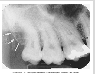 <p><span><span>·</span></span><span style="font-family: "Times New Roman"; line-height: normal; font-size: 7pt;"><span> </span></span><span><span>Rounded prominence of bone that extends posterior to the third molar region</span></span></p><p class="MsoListParagraphCxSpLast"><span><span>·</span></span><span style="font-family: "Times New Roman"; line-height: normal; font-size: 7pt;"><span> </span></span><span><span>A radiopaque bulge distal to the third molar region</span></span></p>