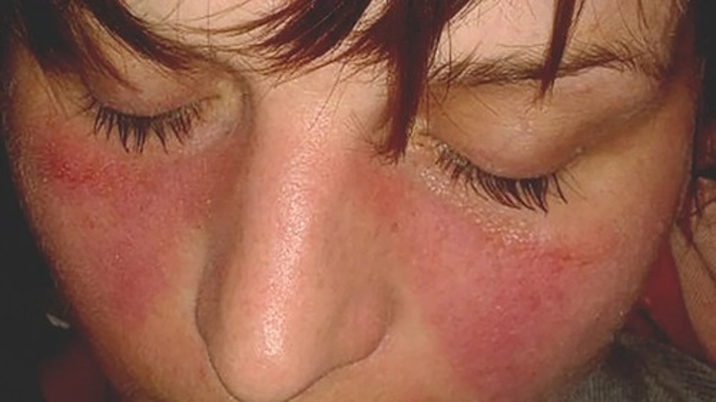 <p>Butterfly rash on the face is something we see in Lupus</p><p>*We would also see photosensitivity and skin lesions</p><p>So keep that in mind when providing nursing education. How would we protect patients from the sun?</p>