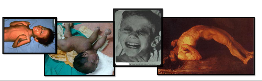 <ul><li><p><span><span>при човека заболяването се развива десцендентно</span></span></p></li><li><p><span><span>първо се предизвиква ригидност (скованост, вцепененост) и гърчове</span></span><br><span><span>на дъвкателната мускулатура. След това се засяга мимическата</span></span><br><span><span>мускулатура, с развитие на характерна мимическа гримаса на</span></span><br><span><span>сардоничен смях. След това се обхваща мускулатурата на врата,</span></span><br><span><span>гръдната стена, гръбначният стълб и крайниците</span></span></p></li><li><p><span><span>при засягане на<br>екстензорните мускули се получава особено дъговидно извиване на<br>тялото (oпистотонус)</span></span></p></li><li><p><span><span>развиват се чести тетанични гърчове. При</span></span><br><span><span>генерализиран тетанус леталитета е 50%. Смъртта настъпва поради</span></span><br><span><span>асфиксия, вследствие спастична парализа на мускулатурата на</span></span><br><span><span>ларинкса и диафрагмата или в резултат на сърдечно-съдов колапс</span></span></p></li></ul><p></p>