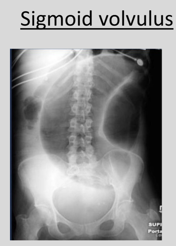 <p>The 'coffee bean sign' is indicative of sigmoid volvulus, a condition in which the sigmoid colon twists on itself.</p>