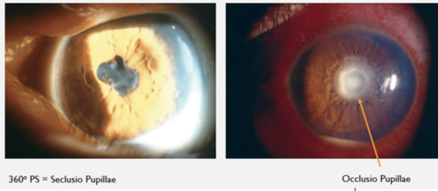 <p>--> Too sticky, can interfere with aqueous flow </p><p>Seclusio pupillae = 360 posterior synechiae </p><p>Occlusio pupillae = collection of fibrous proteins that will melt away with Tx</p>