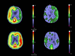 <p>a visual display of brain activity; detects gamma rays emitted by radioactive form of glucose while the brain performs a given task </p>