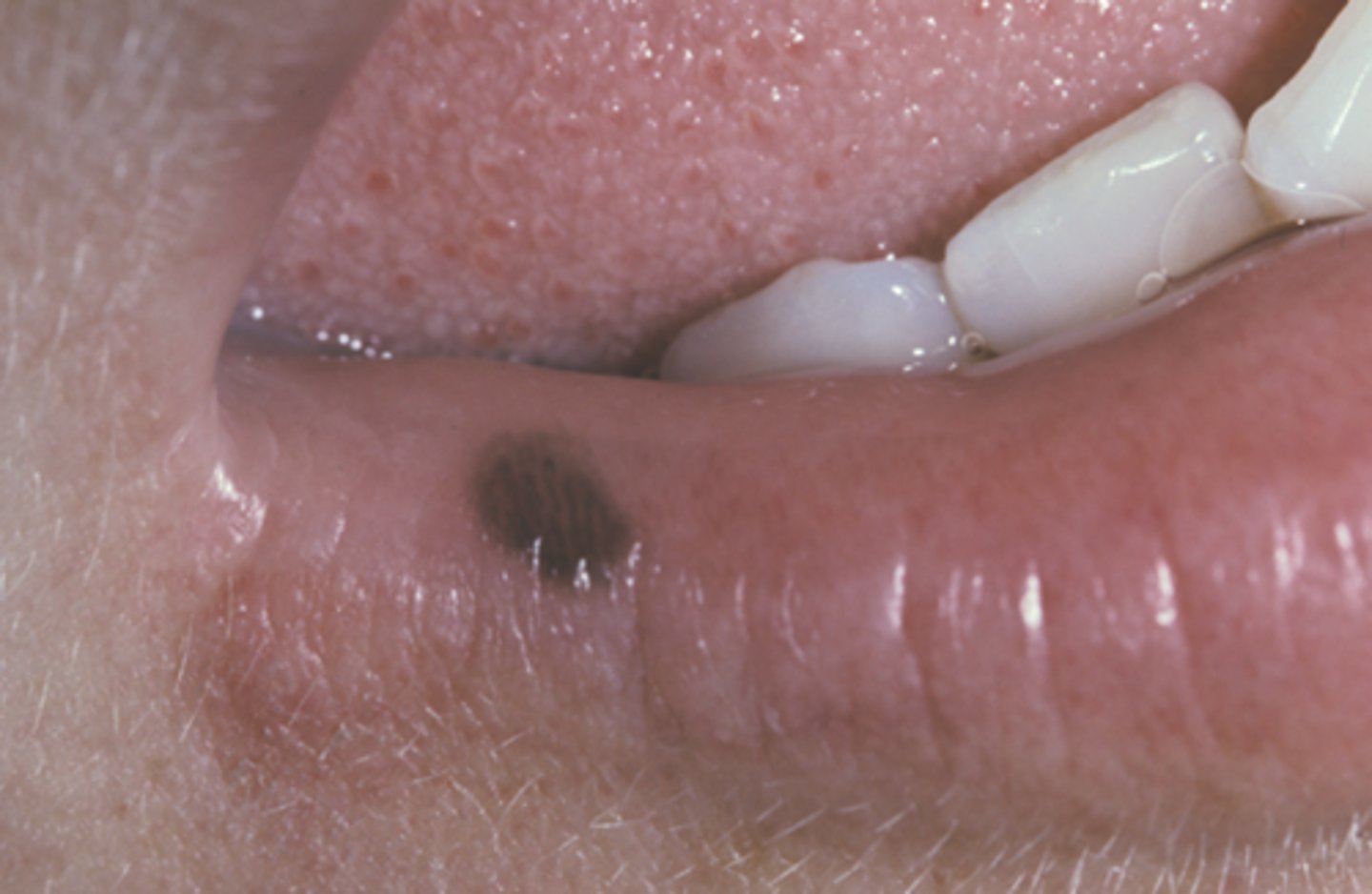 <p>lip freckle</p>