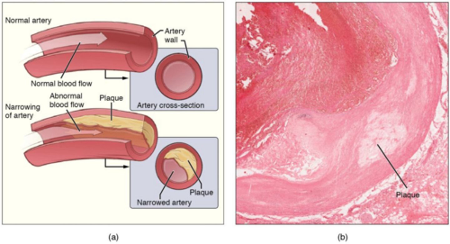 <p>Arterial hardening due to calcium deposition.</p>