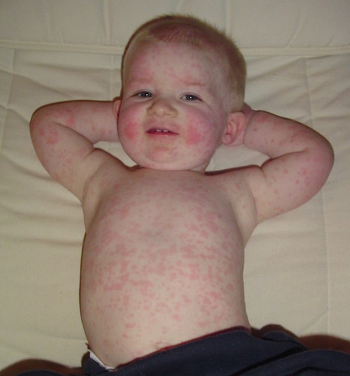 <p>Anemia or hydrops fetalis if pregnant</p>
