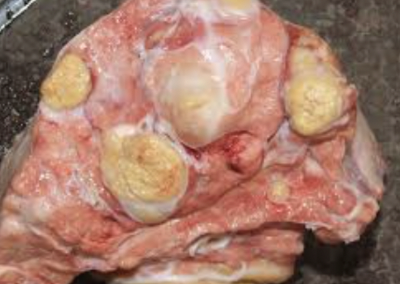 <p>Nodular lesions, often white and calcified</p><p>contain necrosis and macrophages </p>