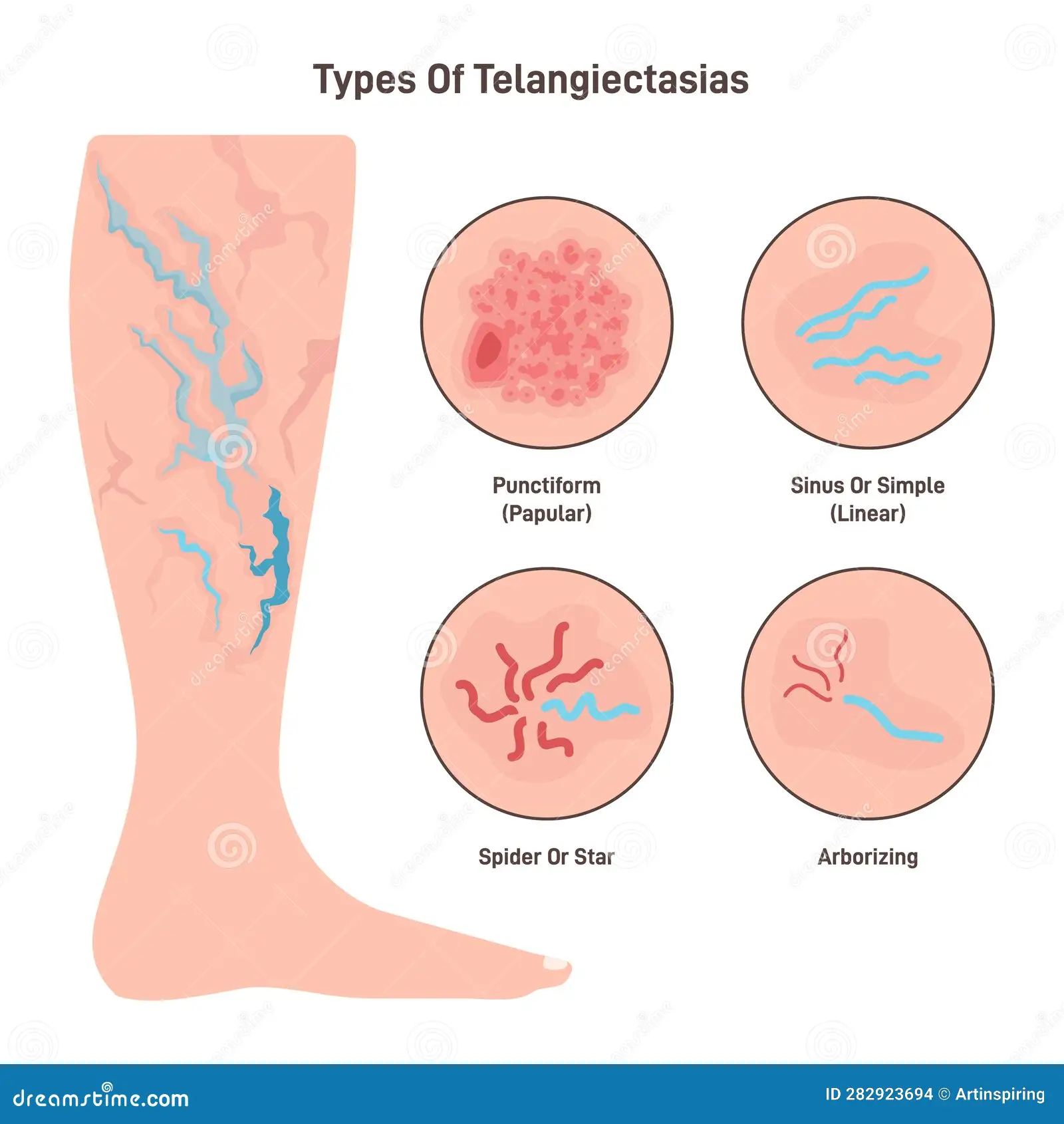 <p>PP: small+linear broken capillaries</p><p>E: injury<br>topical steroids<br>skin cancer</p><p>CM: web-like veins</p><p>TX: none<br>sclerotherapy<br>laser treatment</p>