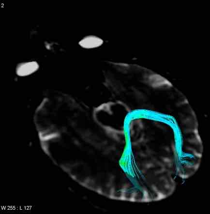 <ul><li><p>włókna spodiła wielkiego łączące ze sobą najdalej ku tyłowie wysunięte punkty biegunów potylicznych</p></li></ul>